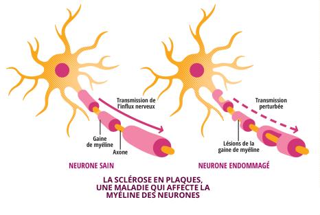 Explication des mécanismes de la sclérose en plaques