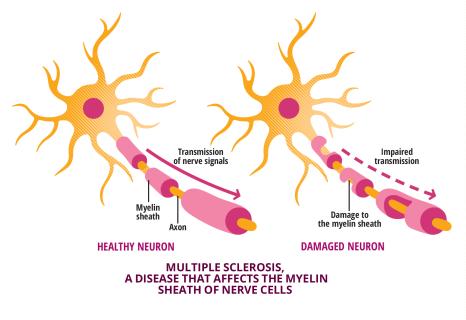Explanation of the multiple sclerosis mecanisms