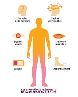 Les symptômes de la sclérose en plaques