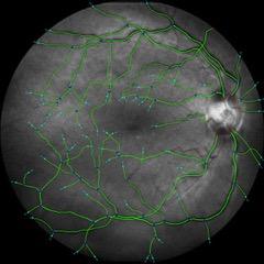 Segmentation du réseau vasculaire de la rétine, avec R. Duits et E. Bekkers (Univ Tu_e Eindhoven)