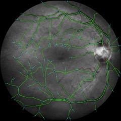 Segmentation of the vascular network of the retina, with R. Duits and E. Bekkers (Univ Tu_e Eindhoven)